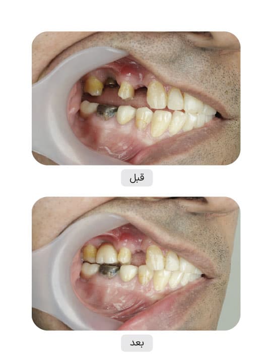 تصویر قبل و بعد درمان ایمپلنت دندان، نمونه 74 در ایران ایمپلنت