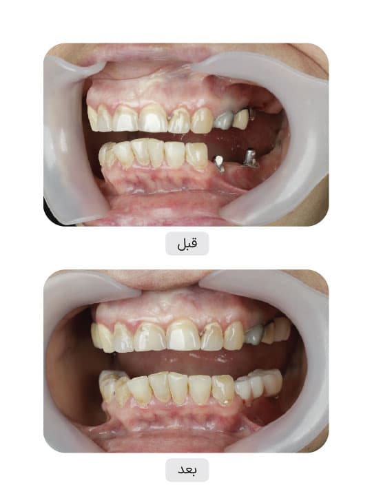 تصویر قبل و بعد درمان ایمپلنت دندان، نمونه 75 در ایران ایمپلنت