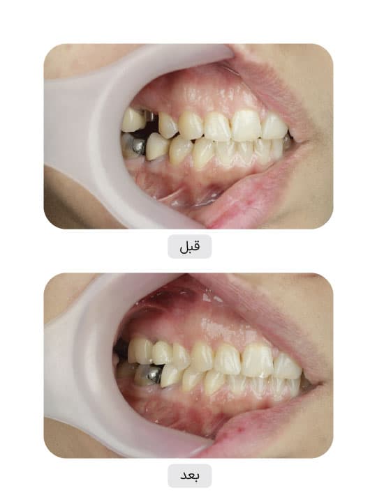 تصویر قبل و بعد درمان ایمپلنت دندان، نمونه 76 در ایران ایمپلنت
