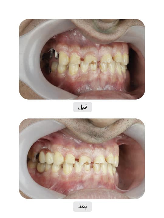 تصویر قبل و بعد درمان ایمپلنت دندان، نمونه 78 در ایران ایمپلنت