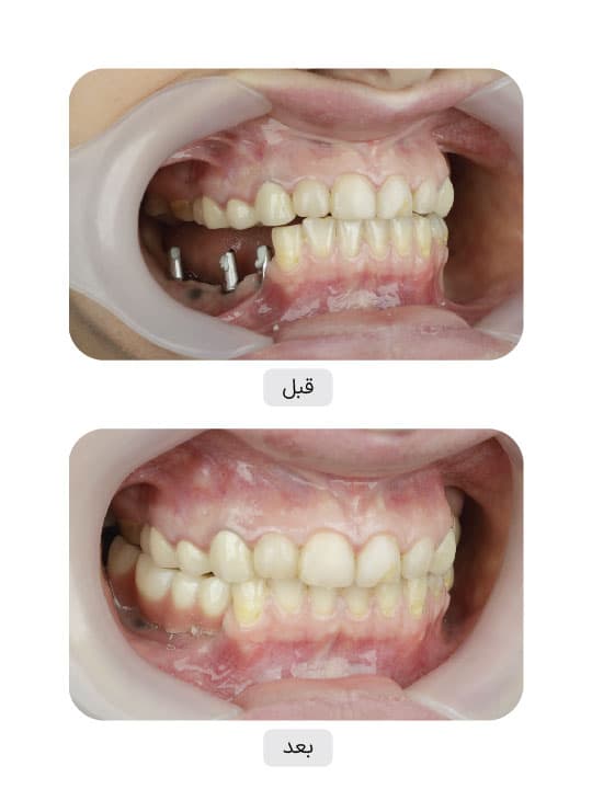 تصویر قبل و بعد درمان ایمپلنت دندان، نمونه 79 در ایران ایمپلنت