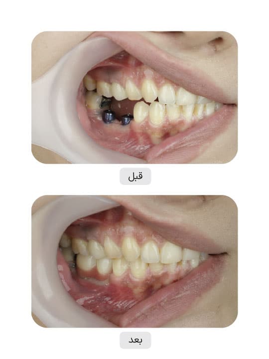 تصویر قبل و بعد درمان ایمپلنت دندان، نمونه 81 در ایران ایمپلنت