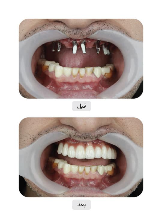 تصویر قبل و بعد درمان ایمپلنت دندان، نمونه 84 در ایران ایمپلنت