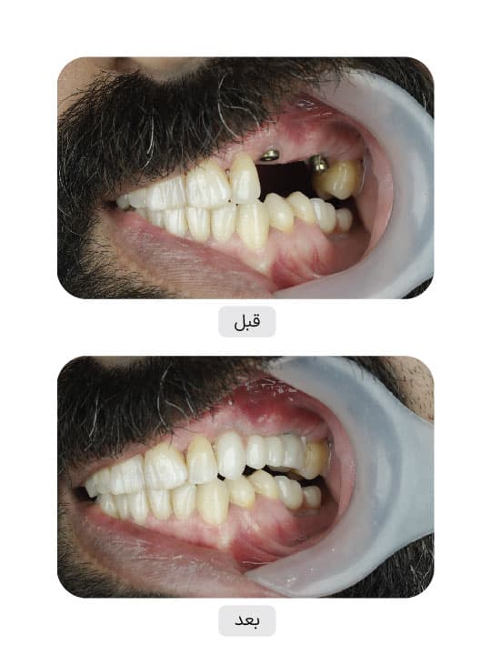 تصویر قبل و بعد درمان ایمپلنت دندان، نمونه 86 در ایران ایمپلنت