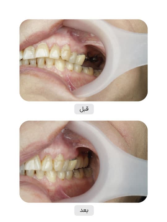 تصویر قبل و بعد درمان ایمپلنت دندان، نمونه 90 در ایران ایمپلنت