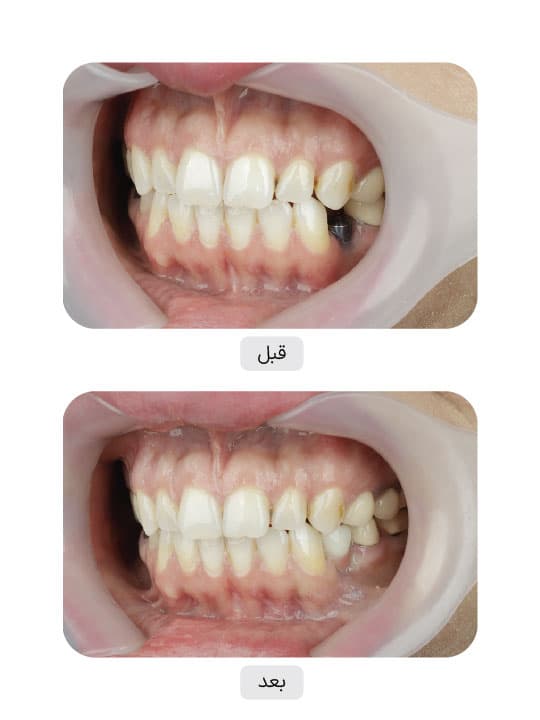 تصویر قبل و بعد درمان ایمپلنت دندان، نمونه 91 در ایران ایمپلنت