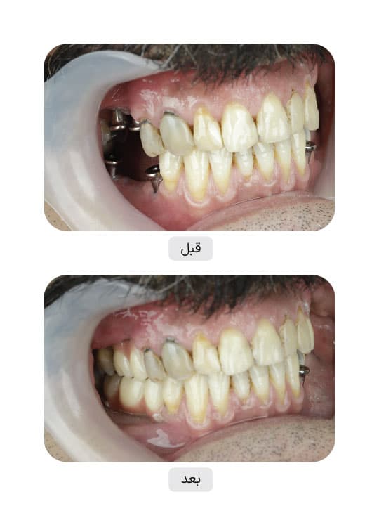 تصویر قبل و بعد درمان ایمپلنت دندان، نمونه 94 در ایران ایمپلنت