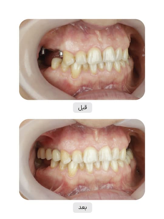 تصویر قبل و بعد درمان ایمپلنت دندان، نمونه 96 در ایران ایمپلنت