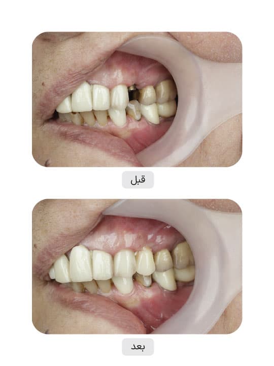 تصویر قبل و بعد درمان ایمپلنت دندان، نمونه 97 در ایران ایمپلنت