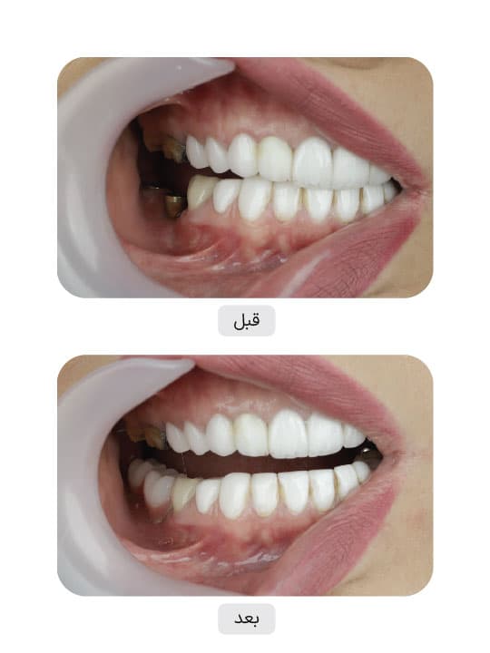 تصویر قبل و بعد درمان ایمپلنت دندان، نمونه 99 در ایران ایمپلنت