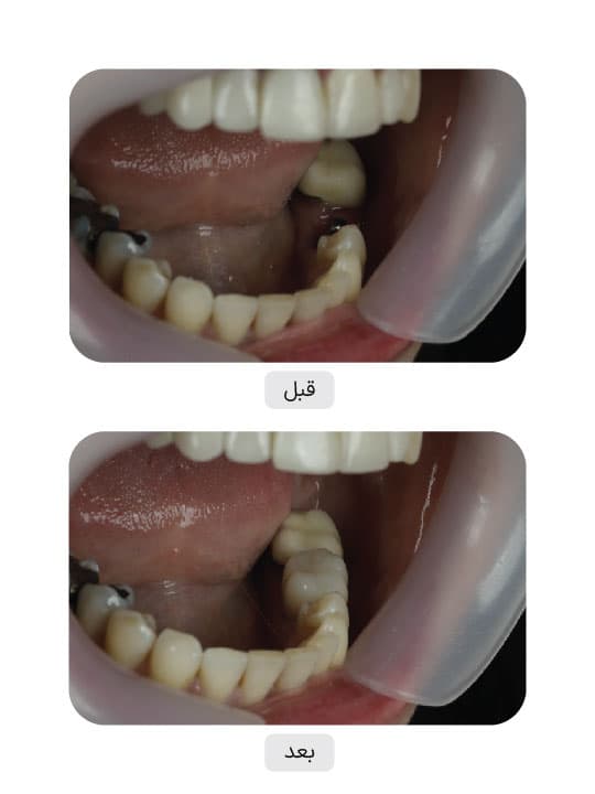 تصویر قبل و بعد درمان ایمپلنت دندان، نمونه 101 در ایران ایمپلنت