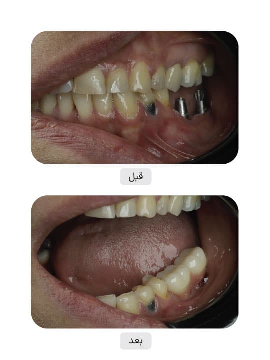 تصویر قبل و بعد درمان ایمپلنت دندان، نمونه 108 در ایران ایمپلنت