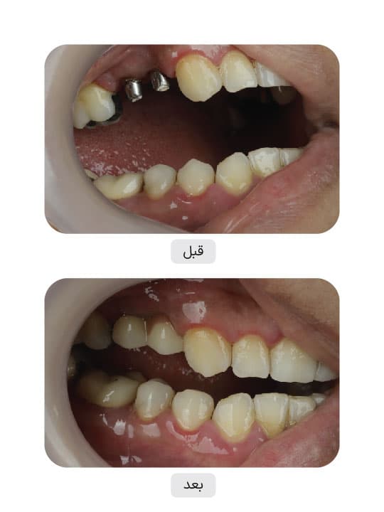 تصویر قبل و بعد درمان ایمپلنت دندان، نمونه 110 در ایران ایمپلنت