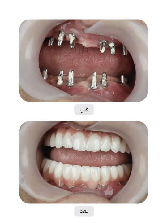 تصویر قبل و بعد درمان ایمپلنت دندان، نمونه 115 در ایران ایمپلنت