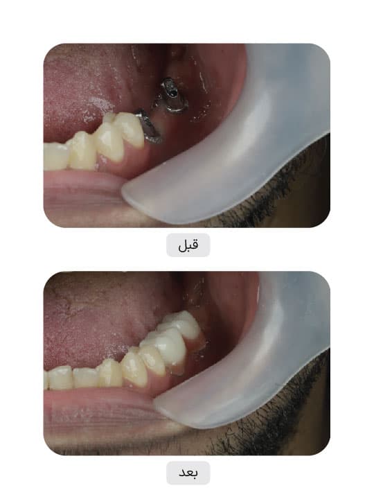 تصویر قبل و بعد درمان ایمپلنت دندان، نمونه 118 در ایران ایمپلنت