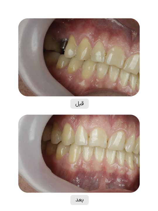 تصویر قبل و بعد درمان ایمپلنت دندان، نمونه 119 در ایران ایمپلنت