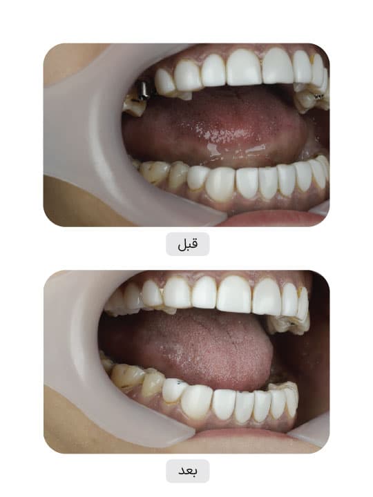 تصویر قبل و بعد درمان ایمپلنت دندان، نمونه 121 در ایران ایمپلنت