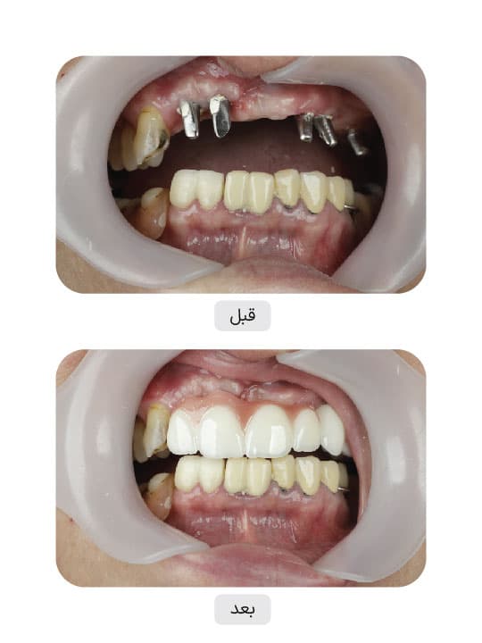 تصویر قبل و بعد درمان ایمپلنت دندان، نمونه 122 در ایران ایمپلنت