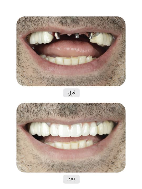 تصویر قبل و بعد درمان ایمپلنت دندان، نمونه 127 در ایران ایمپلنت