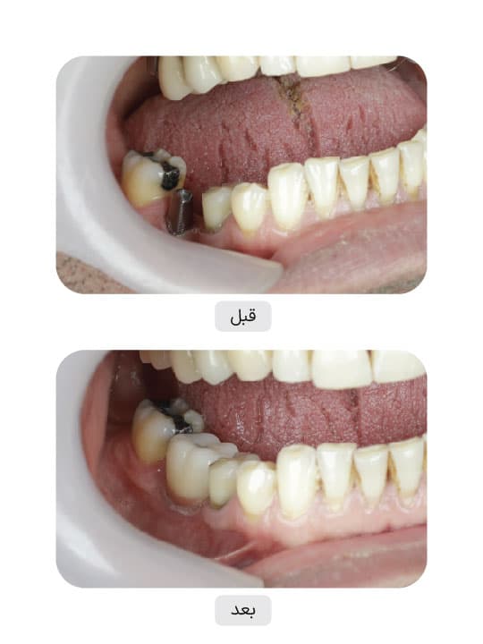 تصویر قبل و بعد درمان ایمپلنت دندان، نمونه 131 در ایران ایمپلنت