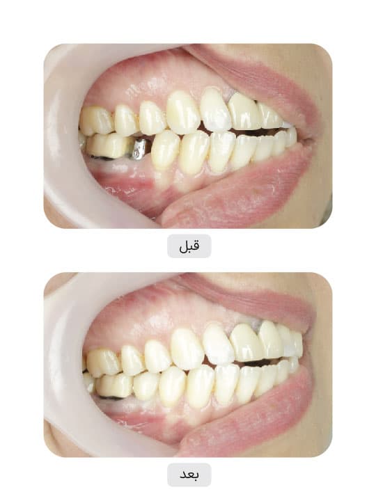 تصویر قبل و بعد درمان ایمپلنت دندان، نمونه 132 در ایران ایمپلنت
