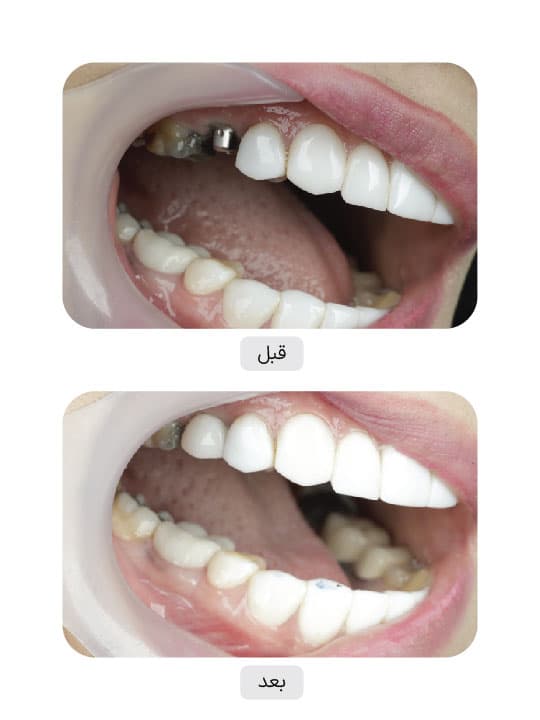 تصویر قبل و بعد درمان ایمپلنت دندان، نمونه 133 در ایران ایمپلنت