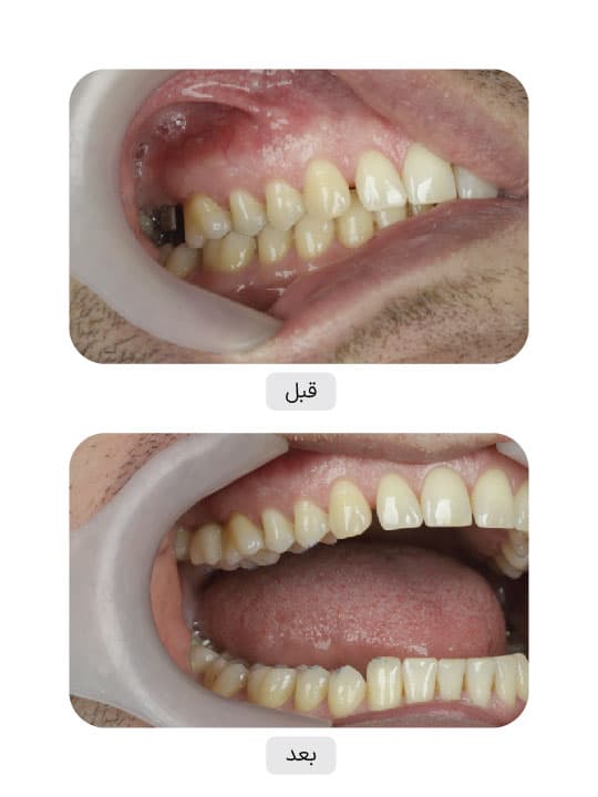 تصویر قبل و بعد درمان ایمپلنت دندان، نمونه 136 در ایران ایمپلنت