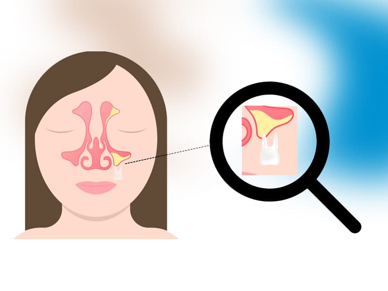 درمان دندان درد سینوسی