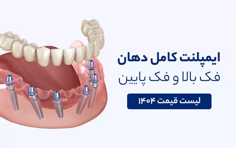 قیمت ایمپلنت کامل دهان و فک بالا و پایین 1404