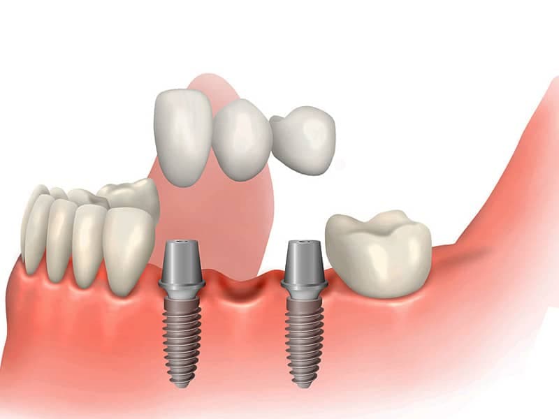 هر واحد ایمپلنت چند دندان است؟