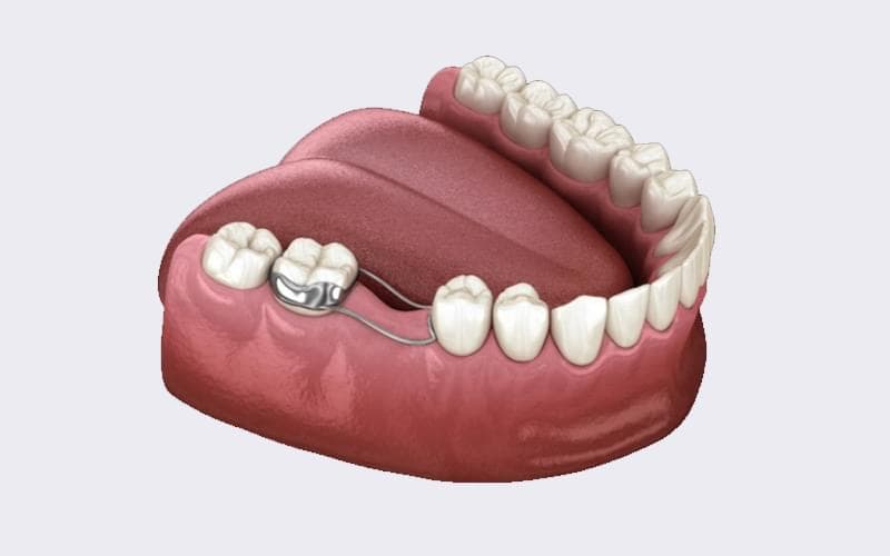 فضا نگهدارنده دندان کودک چیست؟